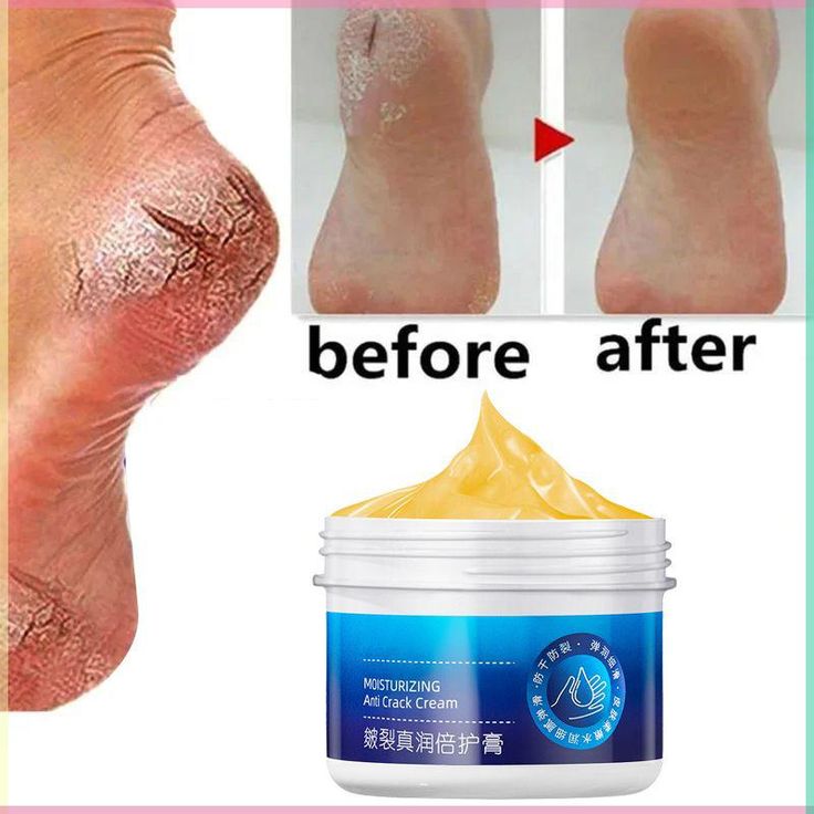 Anti Crack Foot Cream
